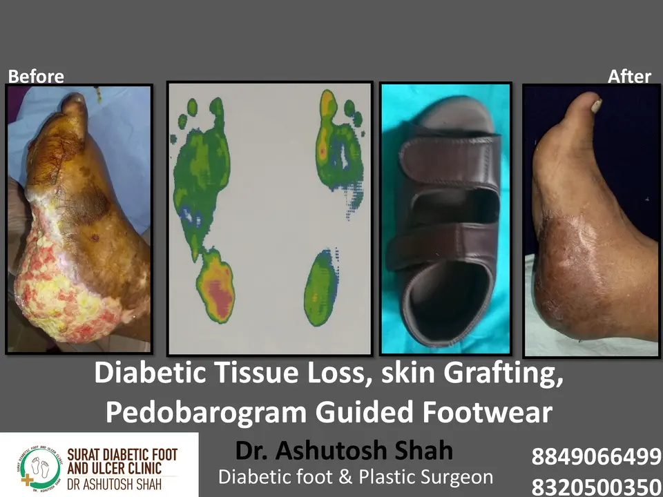 Investigations for Diabetic Foot.pptx-5.webp